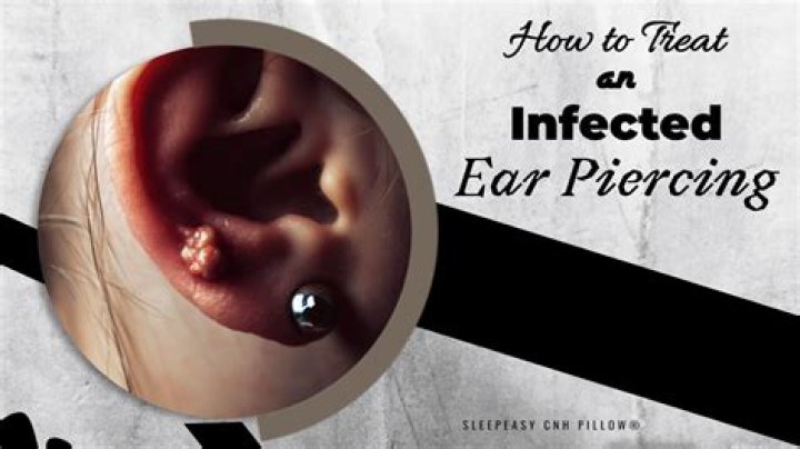Claire's Ear Piercing Infection: Causes, Symptoms, And Treatment
