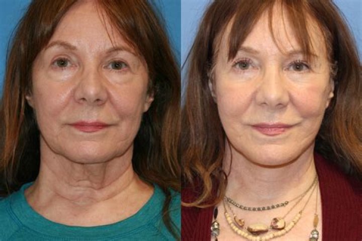 Patricia Heaton Cosmetic Surgery: Before And After Transformations