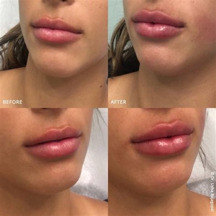 Remarkable Lip Enhancement: Explore Men's Lip Fillers Before And After