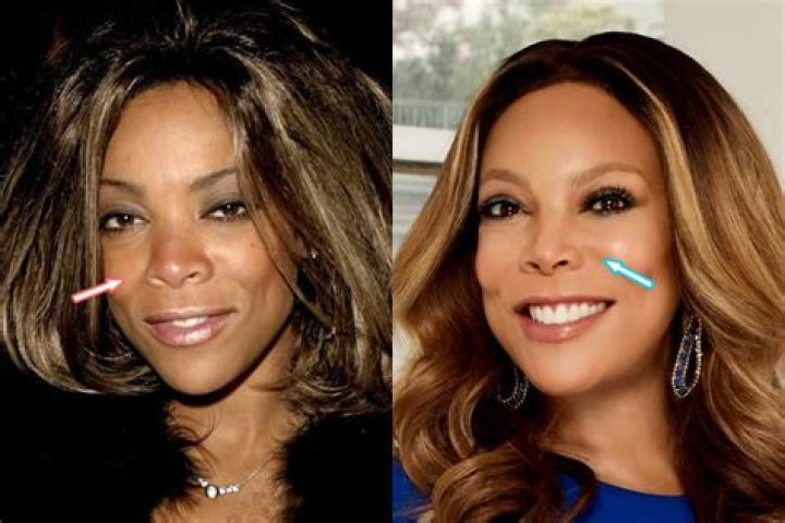 Wendy Williams' Nose Job Mystery Solved